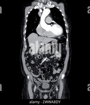 La vista coronale di imaging dell'aorta intera con visualizzazione di un aneurisma aortico fornisce una valutazione completa per una diagnosi accurata e una pianificazione del trattamento. Foto Stock