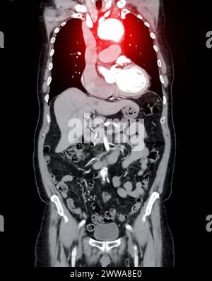 La vista coronale di imaging dell'aorta intera con visualizzazione di un aneurisma aortico fornisce una valutazione completa per una diagnosi accurata e una pianificazione del trattamento. Foto Stock