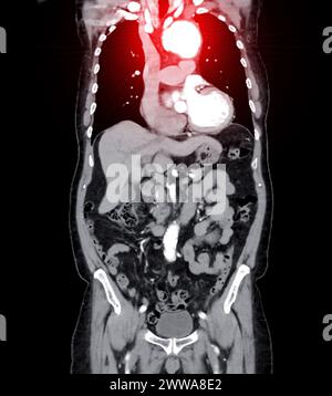 La vista coronale di imaging dell'aorta intera con visualizzazione di un aneurisma aortico fornisce una valutazione completa per una diagnosi accurata e una pianificazione del trattamento. Foto Stock