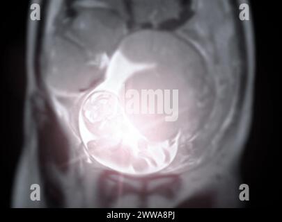 La risonanza magnetica durante la gravidanza assicura una valutazione non invasiva della salute fetale, della sicurezza materna, dell'assistenza ostetrica e della precisione diagnostica, offrendo un sistema ima dettagliato Foto Stock