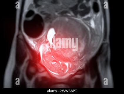 La risonanza magnetica durante la gravidanza assicura una valutazione non invasiva della salute fetale, della sicurezza materna, dell'assistenza ostetrica e della precisione diagnostica, offrendo un sistema ima dettagliato Foto Stock