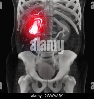 Risonanza magnetica colangiopancreatografia o MRCP che mostra i dotti cistifellea, biliari e pancreatici sull'osso 3D. Foto Stock