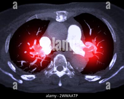 Un'arteria polmonare CTA rivela una vista dettagliata dei vasi sanguigni polmonari, catturando la presenza di embolia polmonare, una condizione in cui una cl ematica Foto Stock