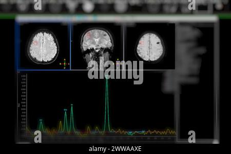 La spettroscopia RM aiuta nelle malattie da ictus, fornendo analisi chimiche approfondite per comprendere i cambiamenti metabolici nei tessuti cerebrali interessati. Foto Stock
