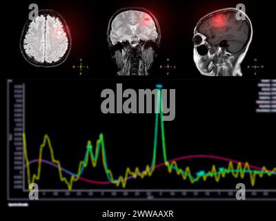 La spettroscopia RM aiuta nelle malattie da ictus, fornendo analisi chimiche approfondite per comprendere i cambiamenti metabolici nei tessuti cerebrali interessati. Foto Stock