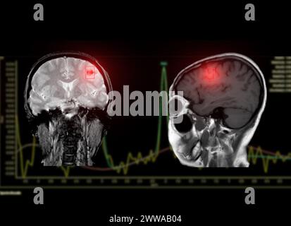 La spettroscopia RM aiuta nelle malattie da ictus, fornendo analisi chimiche approfondite per comprendere i cambiamenti metabolici nei tessuti cerebrali interessati. Foto Stock