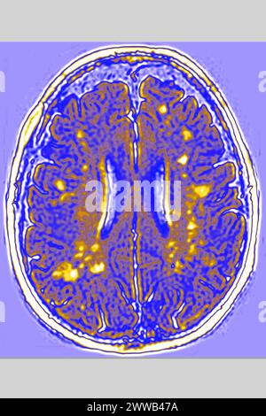 Leukoaraiosi (danno ai piccoli vasi della sostanza bianca cerebrale di origine vascolare negli anziani). RM cerebrale radiale nella sezione radiale. Foto Stock
