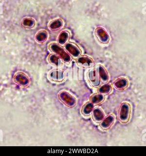 Pneumococco (Streptococcus pneumoniae), pneumococco è un batterio coinvolto in polmonite, broncopolmonite, pleurisia purulenta, meningite batterica. Foto Stock