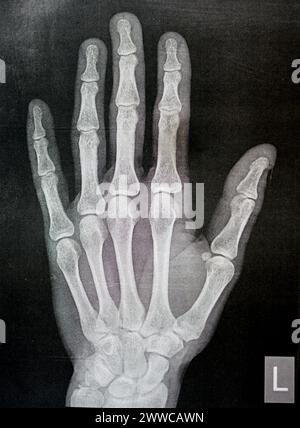 Radiografia semplice della mano sinistra di un maschio adulto dopo un trauma diretto al dito del pollice sinistro che mostra un normale studio osseo, radiografia normale della mano ad ex Foto Stock