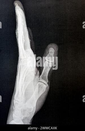Radiografia semplice della mano sinistra di un maschio adulto dopo un trauma diretto al dito del pollice sinistro che mostra un normale studio osseo, radiografia normale della mano ad ex Foto Stock