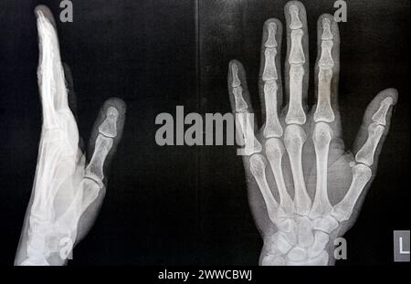Radiografia semplice della mano sinistra di un maschio adulto dopo un trauma diretto al dito del pollice sinistro che mostra un normale studio osseo, radiografia normale della mano ad ex Foto Stock