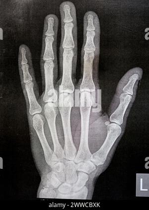 Radiografia semplice della mano sinistra di un maschio adulto dopo un trauma diretto al dito del pollice sinistro che mostra un normale studio osseo, radiografia normale della mano ad ex Foto Stock