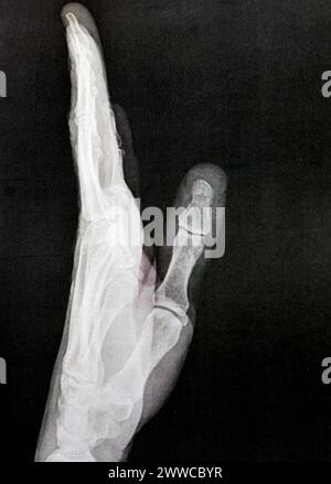 Radiografia semplice della mano sinistra di un maschio adulto dopo un trauma diretto al dito del pollice sinistro che mostra un normale studio osseo, radiografia normale della mano ad ex Foto Stock