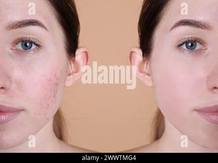 Problema di acne. Giovane donna prima e dopo il trattamento su sfondo beige, primo piano. Collage di foto Foto Stock