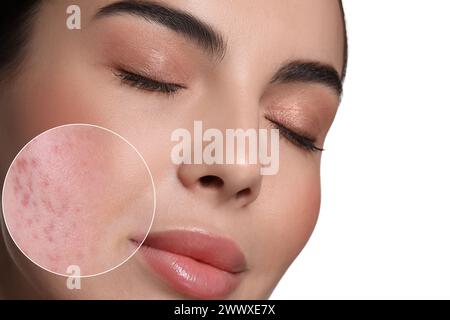 Donna con l'acne sul viso su sfondo bianco. Area ingrandita che mostra problemi di pelle Foto Stock