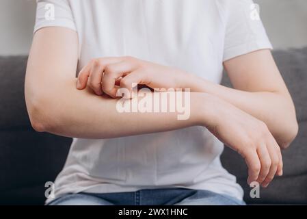 Primo piano di una giovane donna caucasica con reazione allergica da atopi, punture di insetti sul braccio, prurito alla mano, prurito rosso o eruzione cutanea dello sci Foto Stock