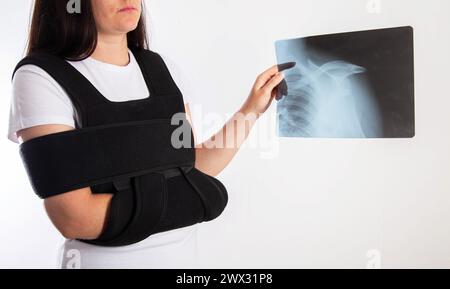 Una ragazza tiene una radiografia di una lussazione e frattura dell'omero in una benda sull'articolazione della spalla dopo un'operazione chirurgica. Foto Stock