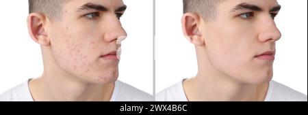 Problema di acne. Giovane uomo prima e dopo il trattamento su sfondo bianco, collage di foto Foto Stock