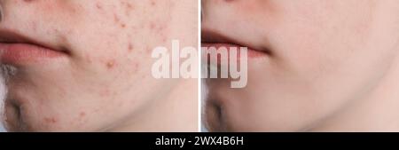 Problema di acne. Giovane uomo prima e dopo il trattamento, primo piano. Collage di foto Foto Stock