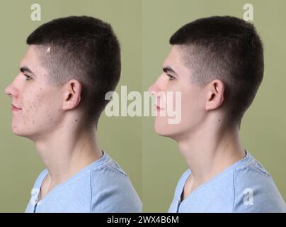 Problema di acne. Giovane uomo prima e dopo il trattamento su sfondo verde, collage di foto Foto Stock