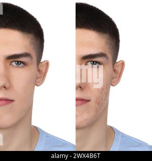 Problema di acne. Giovane uomo prima e dopo il trattamento su sfondo bianco, collage di foto Foto Stock