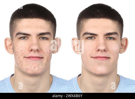 Problema di acne. Giovane uomo prima e dopo il trattamento su sfondo bianco, collage di foto Foto Stock