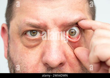 Arrossamento dell'occhio, possibili conseguenze di rottura capillare o infezione, emorragia visibile. Primo piano della faccia di un uomo. Foto Stock