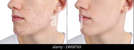 Problema di acne. Giovane uomo prima e dopo il trattamento su sfondo bianco, primo piano. Collage di foto Foto Stock