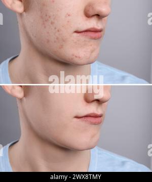 Problema di acne. Giovane uomo prima e dopo il trattamento su sfondo grigio, primo piano. Collage di foto Foto Stock