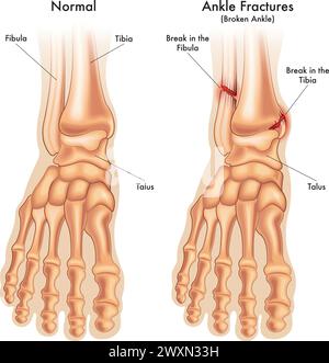 l'illustrazione medica mette a confronto una caviglia normale del piede, con una caviglia del piede fratturata in due punti, con annotazioni. Illustrazione Vettoriale