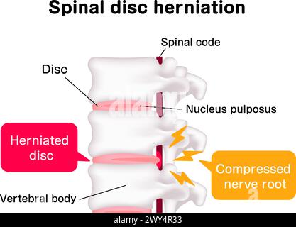 Illustrazione del vettore di erniazione del disco spinale Illustrazione Vettoriale