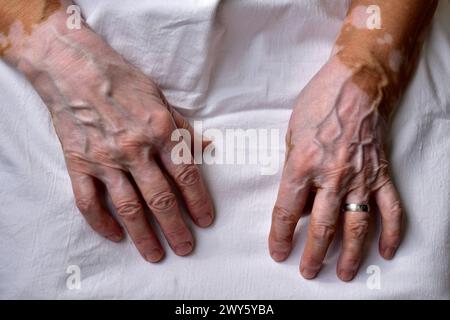 L'immagine mostra un primo piano delle mani di una donna anziana danneggiata dalla vitiligine della malattia. Foto Stock