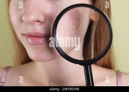 Giovane donna con problemi di acne che tiene la lente d'ingrandimento vicino alla sua pelle su sfondo di oliva, primo piano Foto Stock