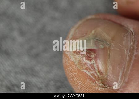 Primo piano della piastra della sponda del piede danneggiata. Unghie e malattie della pelle fungo. Foto Stock