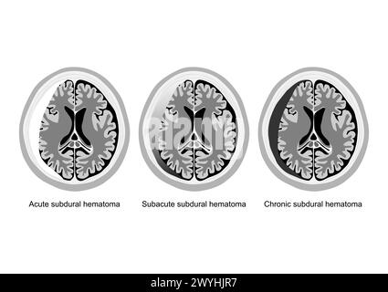 Tre illustrazioni mediche che mostrano fasi acute, subacute e croniche di ematoma subdurale nella lesione cerebrale. Illustrazione Vettoriale