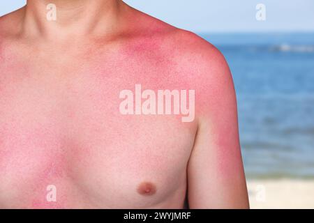 Un uomo con pelle arrossata e pruriginosa dopo scottature. Cura della pelle e protezione dai raggi ultravioletti del sole. Foto Stock