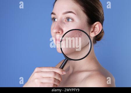 Giovane donna con problemi di acne tenendo la lente di ingrandimento vicino alla pelle su sfondo blu Foto Stock