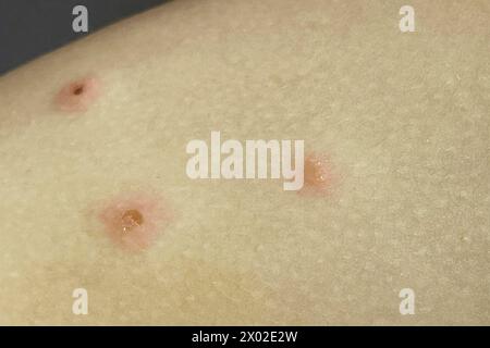 Brufoli graffiati sulla pelle umana. Malattia infettiva. Dermatologia, medicina e assistenza sanitaria. Foto Stock