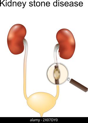 Malattia da calcoli renali. Colica renale. Sistema urinario umano. Lente d'ingrandimento e primo piano di una pietra in Ureter. illustrazione vettoriale isolata su b bianco Illustrazione Vettoriale