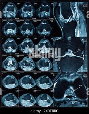 Immagini di tomografia a risonanza magnetica (MRT) del ginocchio Foto Stock