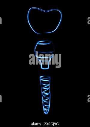 Illustrazione vettoriale isolata dell'impianto dentale con effetto neon. Illustrazione Vettoriale