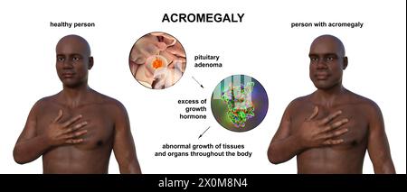 Illustrazione 3D che confronta un uomo sano (a sinistra) e lo stesso uomo con acromegalia (a destra). L'acromegalia è una condizione che causa un aumento delle dimensioni delle mani e del viso a causa della sovrapproduzione di somatotropina (ormone umano della crescita). In genere è il risultato di un tumore benigno (adenoma) che si forma sulla ghiandola ipofisaria. Foto Stock