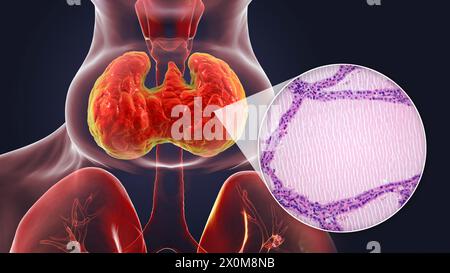 Illustrazione 3D di una persona con gozzo endemico (ghiandola tiroidea allargata, base del collo) e un primo piano del tessuto tiroideo interessato. I gozzi endemici sono causati da una mancanza di iodio. È considerato endemico quando è presente in oltre il 5% della popolazione di una determinata area, o oltre il 10% della popolazione scolastica. Foto Stock