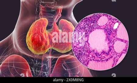 Illustrazione 3D di una persona con gozzo tossico (ghiandola tiroidea allargata, base del collo) e un primo piano del tessuto tiroideo interessato. Un gozzo è considerato tossico quando l'ingrossamento della ghiandola tiroidea produce anche un eccesso di ormone tiroideo. Foto Stock