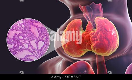 Illustrazione 3D di una persona con gozzo tossico (ghiandola tiroidea allargata, base del collo) e un primo piano del tessuto tiroideo interessato. Un gozzo è considerato tossico quando l'ingrossamento della ghiandola tiroidea produce anche un eccesso di ormone tiroideo. Foto Stock