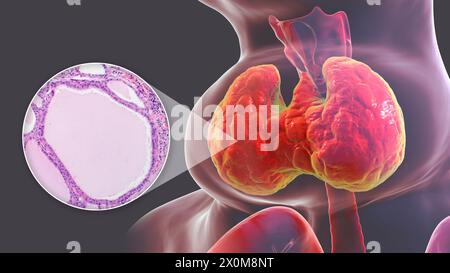 Illustrazione 3D di una persona con gozzo endemico (ghiandola tiroidea allargata, base del collo) e un primo piano del tessuto tiroideo interessato. I gozzi endemici sono causati da una mancanza di iodio. È considerato endemico quando è presente in oltre il 5% della popolazione di una determinata area, o oltre il 10% della popolazione scolastica. Foto Stock
