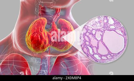 Illustrazione 3D di una persona con gozzo endemico (ghiandola tiroidea allargata, base del collo) e un primo piano del tessuto tiroideo interessato. I gozzi endemici sono causati da una mancanza di iodio. È considerato endemico quando è presente in oltre il 5% della popolazione di una determinata area, o oltre il 10% della popolazione scolastica. Foto Stock