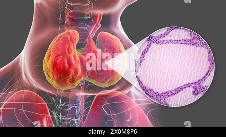 Illustrazione 3D di una persona con gozzo endemico (ghiandola tiroidea allargata, base del collo) e un primo piano del tessuto tiroideo interessato. I gozzi endemici sono causati da una mancanza di iodio. È considerato endemico quando è presente in oltre il 5% della popolazione di una determinata area, o oltre il 10% della popolazione scolastica. Foto Stock