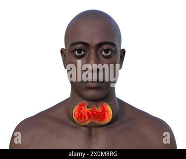 Illustrazione 3D di un uomo con una ghiandola tiroidea allargata (gozzo, base del collo) e sporgenza anormale degli occhi (esoftalmo). Questi sono due sintomi di una ghiandola tiroidea iperattiva, nota come ipertiroidismo. Foto Stock