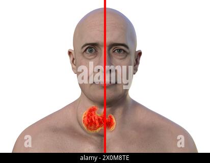 Illustrazione 3D di un uomo con una ghiandola tiroidea allargata (gozzo, base del collo) e protrusione anormale degli occhi (esoftalmo), e lo stesso uomo con tiroide sana e occhi per confronto (destra). Questi sono due sintomi di una ghiandola tiroidea iperattiva, nota come ipertiroidismo. Foto Stock